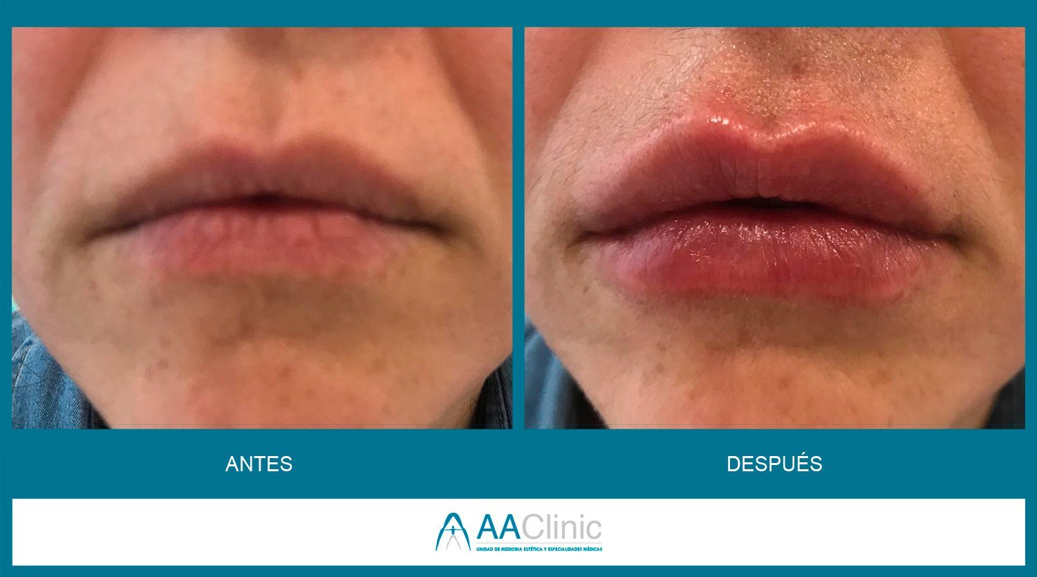 Antes y Después Ácido Hialurónico | AA Clinic